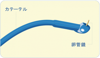 FT手術で使用する卵管鏡とバルーンカテーテルの器具図