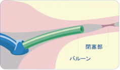 FT手術の手順1|バルーンカテーテルを卵管口へ挿入する図解