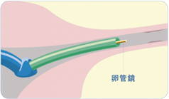 FT手術の手順3|卵管鏡で開通を確認する図解